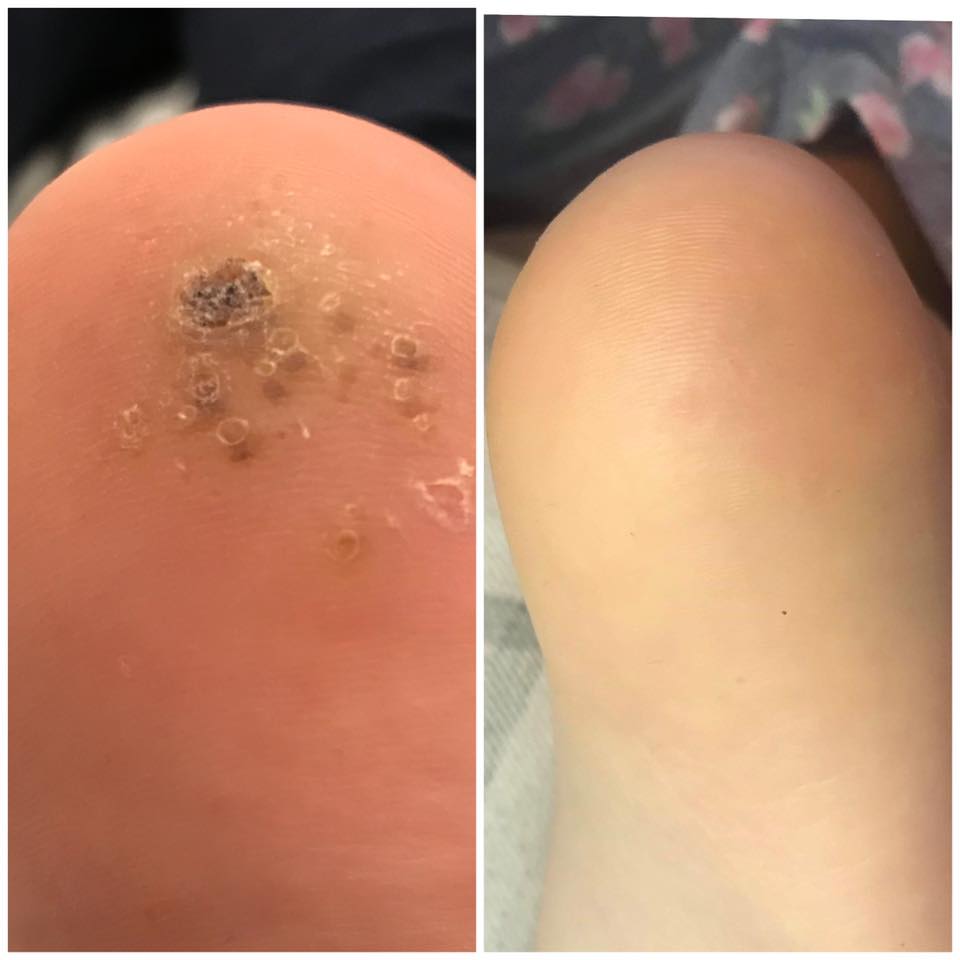 Verruca removal after two cryotherapy sessions